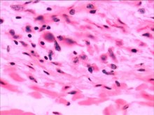 汉坦病毒 汉坦病毒